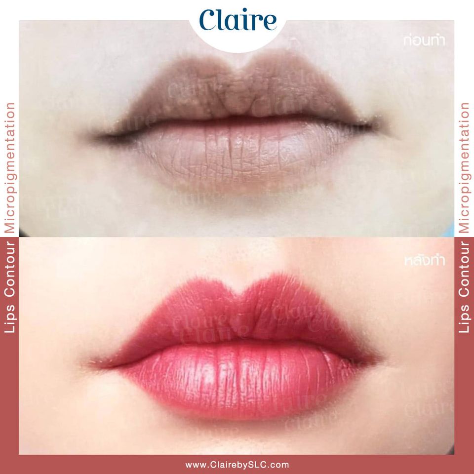 Claire by SLC บริการเลเซอร์ปากชมพู - 2