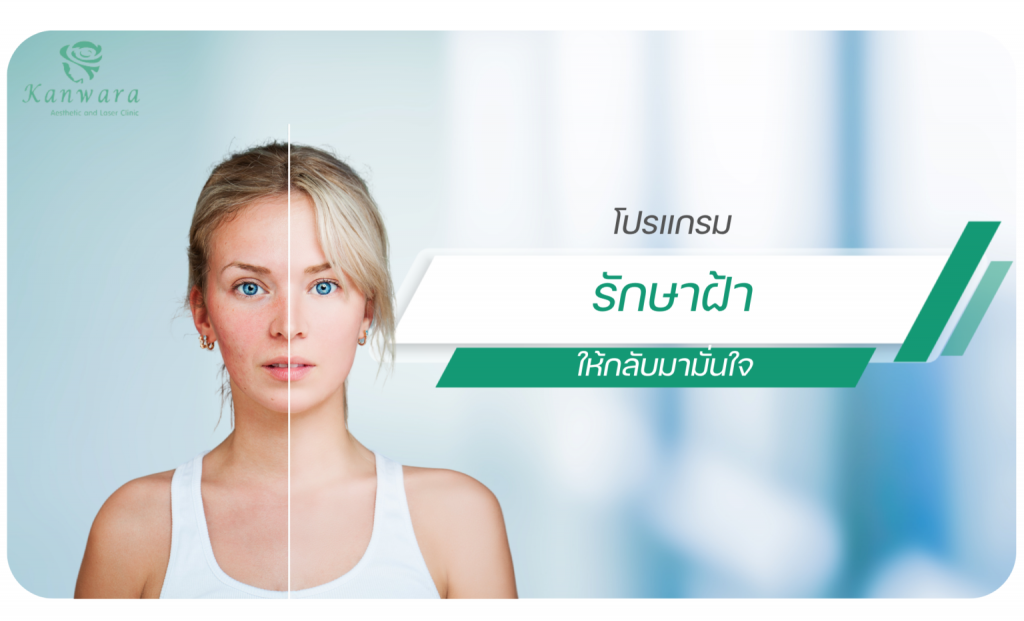 10 อันดับ เลเซอร์ฝ้ากระ ที่ไหนดี แก้ปัญหาผิวหมองคล้ำ ผิวขาว กระจ่างใส กลับมาได้อีกครั้ง 13 Kanwara Clinic บริการเลเซอร์ฝ้ากระ - 1