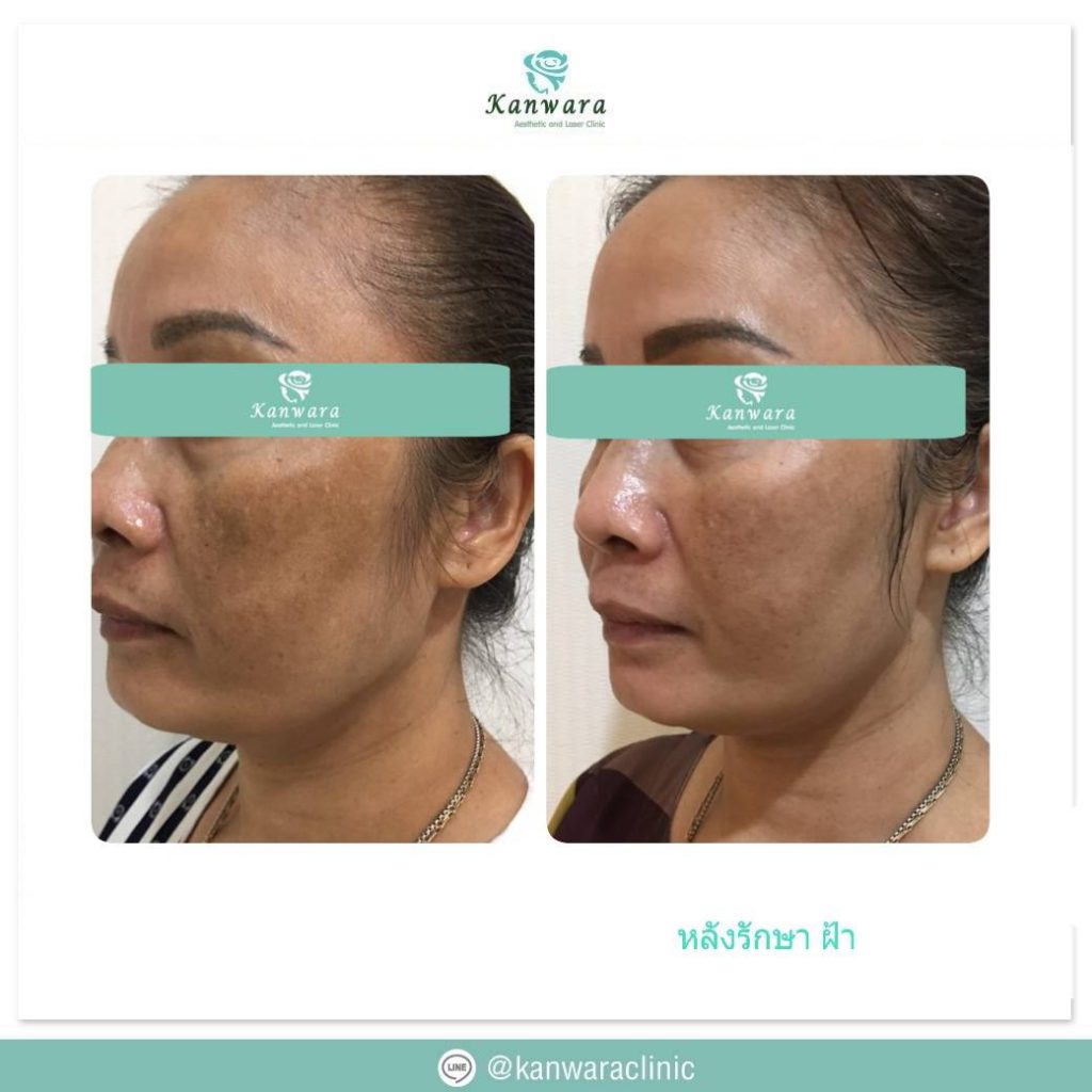 10 อันดับ เลเซอร์ฝ้ากระ ที่ไหนดี แก้ปัญหาผิวหมองคล้ำ ผิวขาว กระจ่างใส กลับมาได้อีกครั้ง 14 Kanwara Clinic บริการเลเซอร์ฝ้ากระ - 2