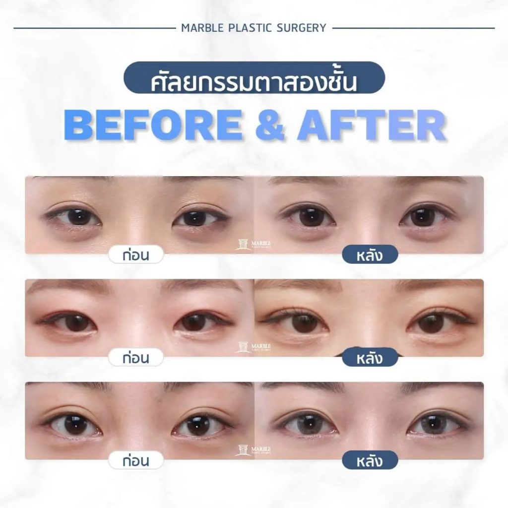 Marble Plastic Surgery ทำตาสองชั้น สไตล์เกาหลี - 2