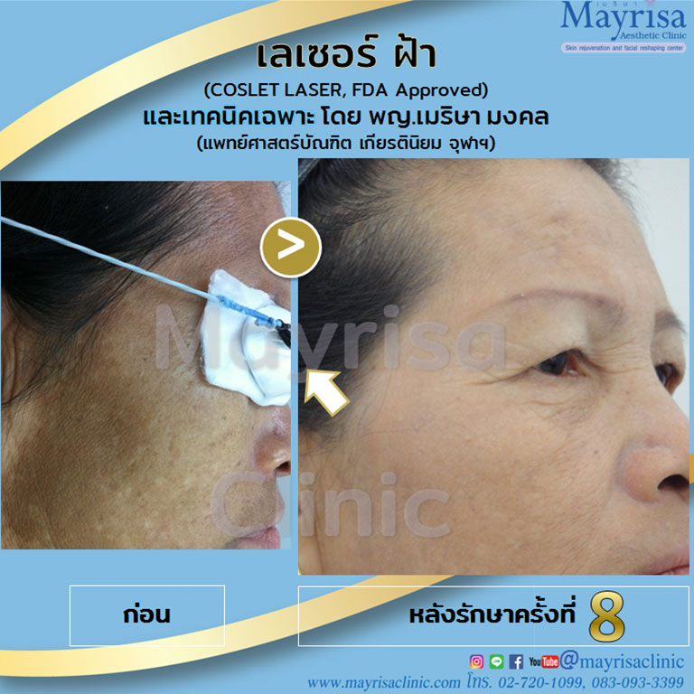 10 อันดับ เลเซอร์ฝ้ากระ ที่ไหนดี แก้ปัญหาผิวหมองคล้ำ ผิวขาว กระจ่างใส กลับมาได้อีกครั้ง 23 Mayrisa Aesthetic Clinic บริการเลเซอร์ฝ้ากระ - 2