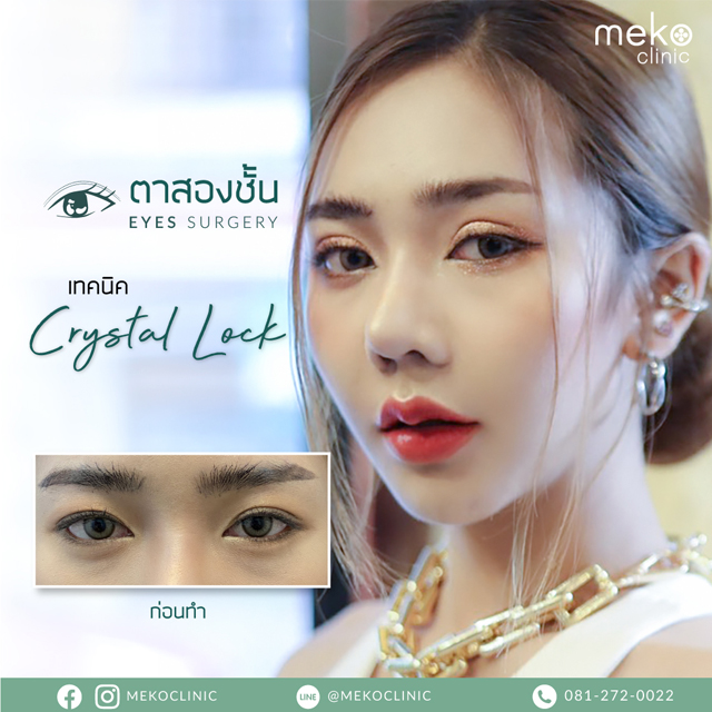 Meko Clinic ทำตาสองชั้น สไตล์เกาหลี - 2