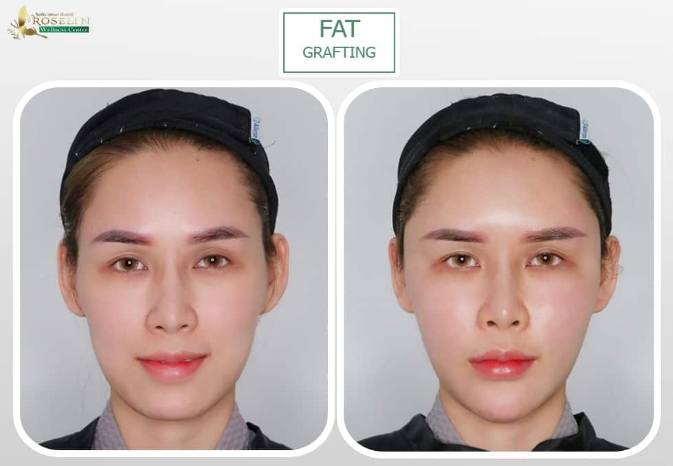 RWC Clinic คลินิกฉีดไขมันหน้า - 2