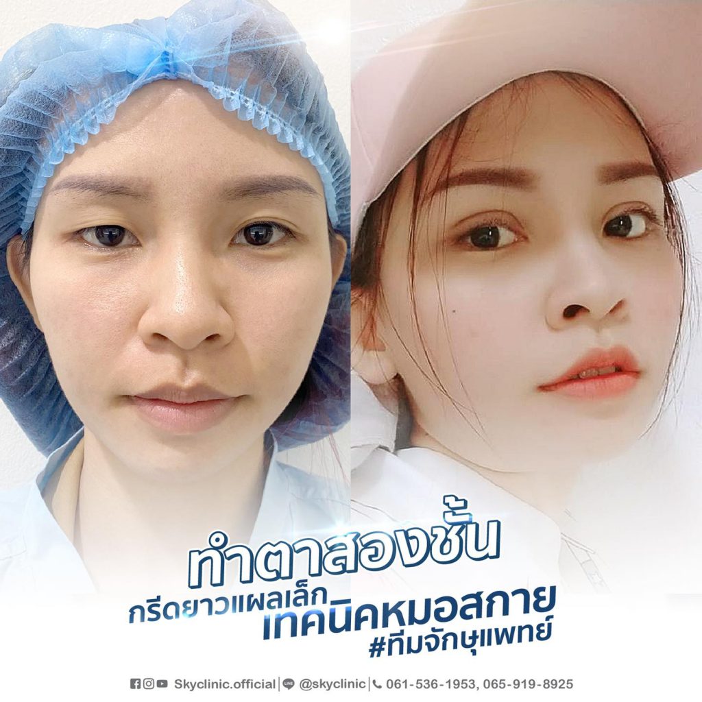 Sky Clinic คลินิกทำตาสองชั้น สไตล์เกาหลี - 2