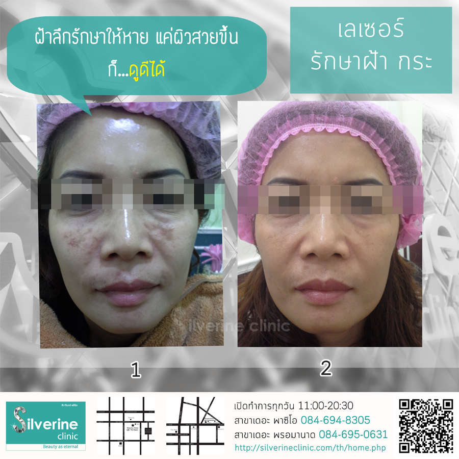10 อันดับ เลเซอร์ฝ้ากระ ที่ไหนดี แก้ปัญหาผิวหมองคล้ำ ผิวขาว กระจ่างใส กลับมาได้อีกครั้ง 10 Sliverine Clinic คลินิกเลเซอร์ฝ้ากระ - 2