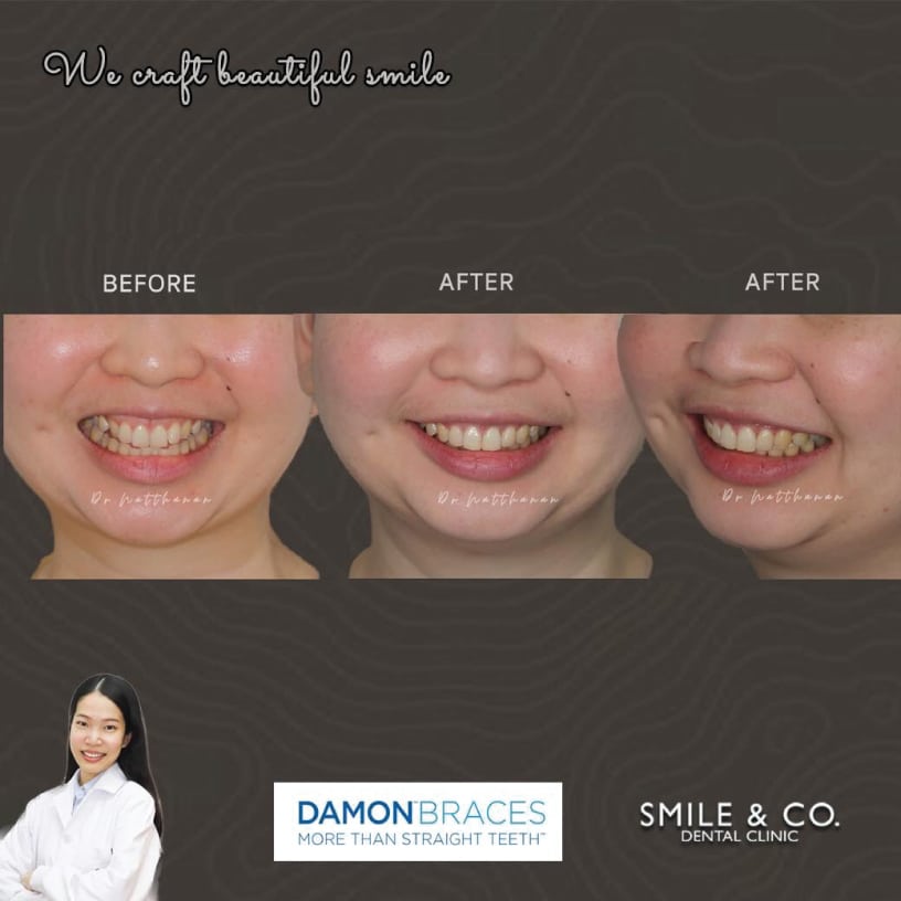 Smile and Co Dentel Clinic บริการจัดฟันแบบดามอน - 2