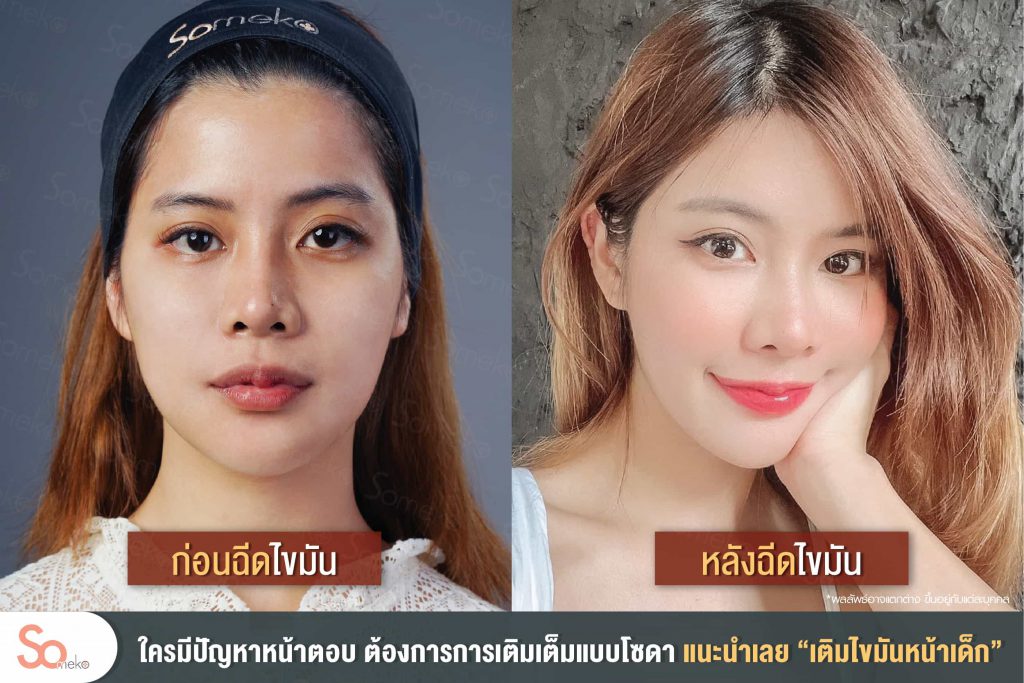 Someko Clinic คลินิกฉีดไขมันหน้า - 2