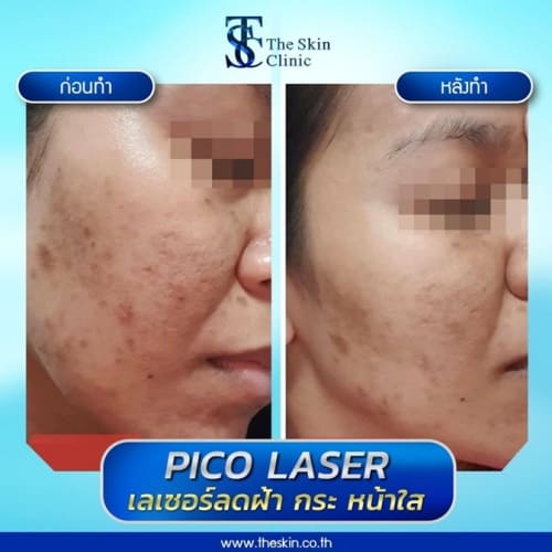The Skin Clinic คลินิกเลเซอร์ฝ้ากระ - 2