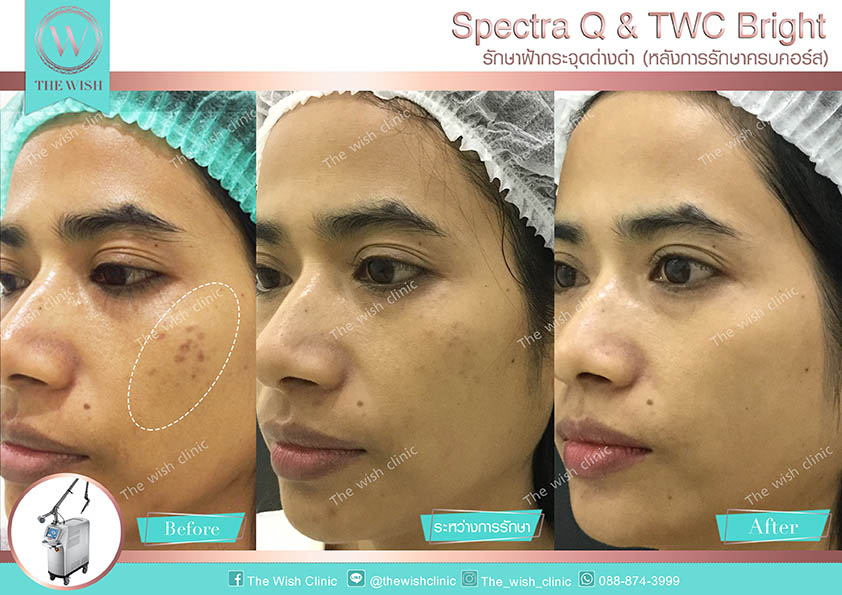 The Wish Clinic คลินิกเลเซอร์ฝ้ากระ - 2