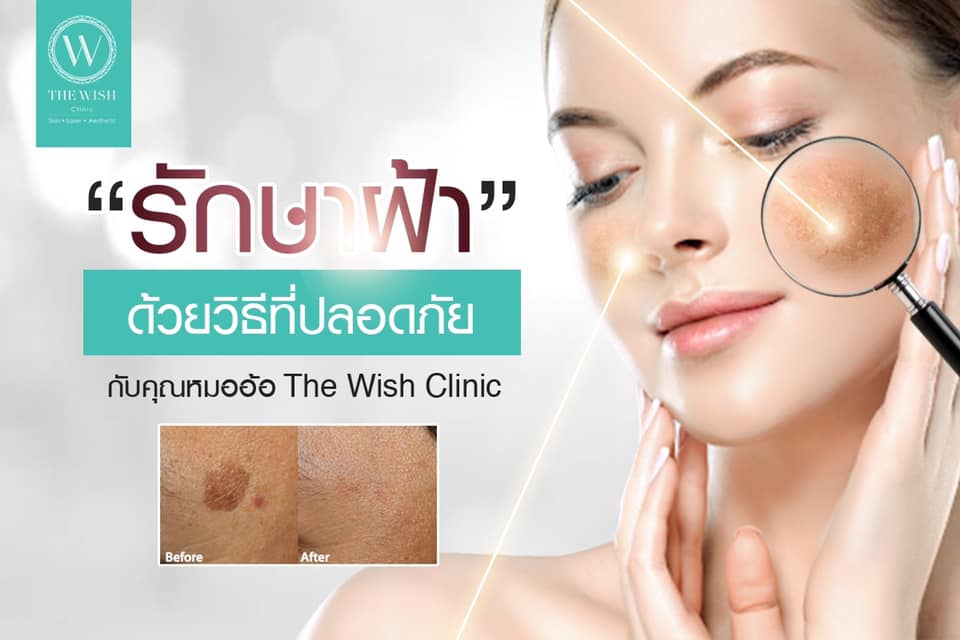 10 อันดับ เลเซอร์ฝ้ากระ ที่ไหนดี แก้ปัญหาผิวหมองคล้ำ ผิวขาว กระจ่างใส กลับมาได้อีกครั้ง 19 The Wish Clinic คลินิกเลเซอร์ฝ้ากระ - 1