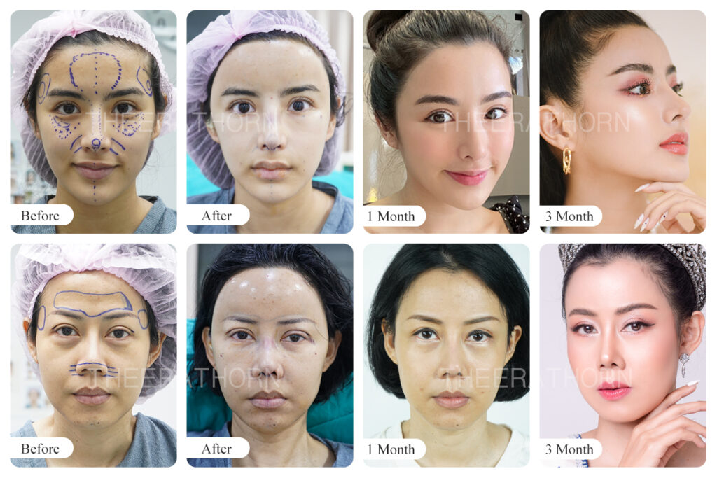 Theerathorn Clinic บริการฉีดไขมันหน้า - 2