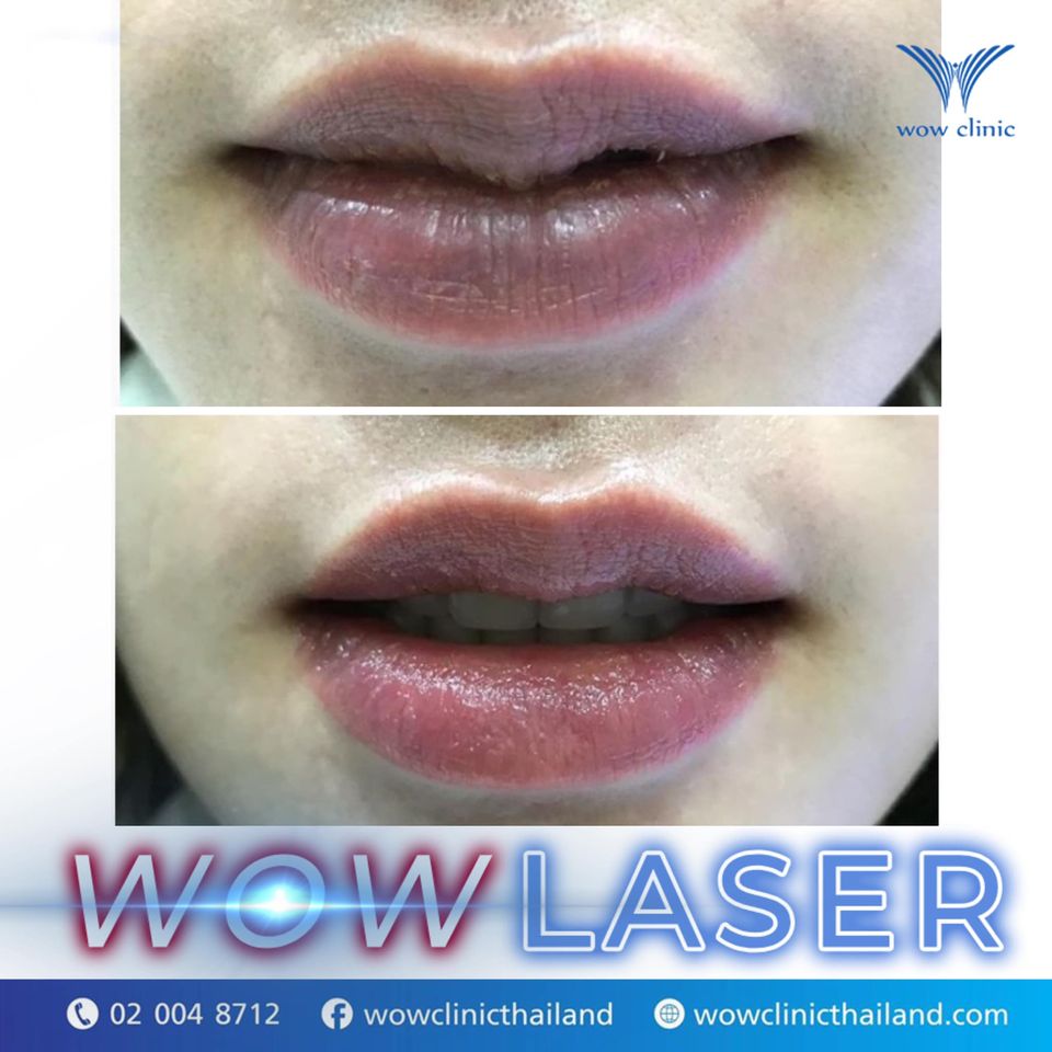 WOW Clinic คลินิกเลเซอร์ปากชมพู - 2