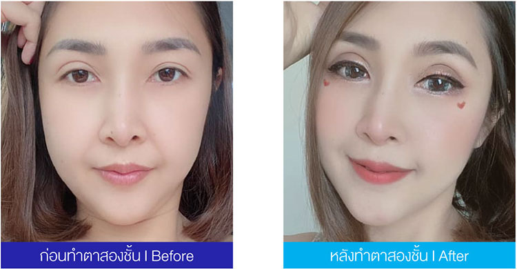 Yanhee Hospital บริการทำตาสองชั้น สไตล์เกาหลี - 2