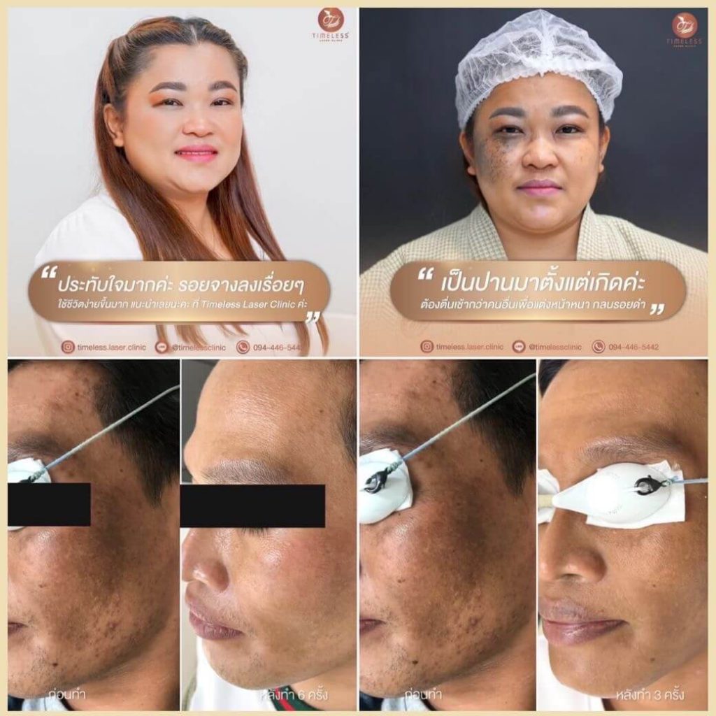 10 อันดับ เลเซอร์ฝ้ากระ ที่ไหนดี แก้ปัญหาผิวหมองคล้ำ ผิวขาว กระจ่างใส กลับมาได้อีกครั้ง 6 คลินิกเลเซอร์ฝ้ากระ Timeless Laser