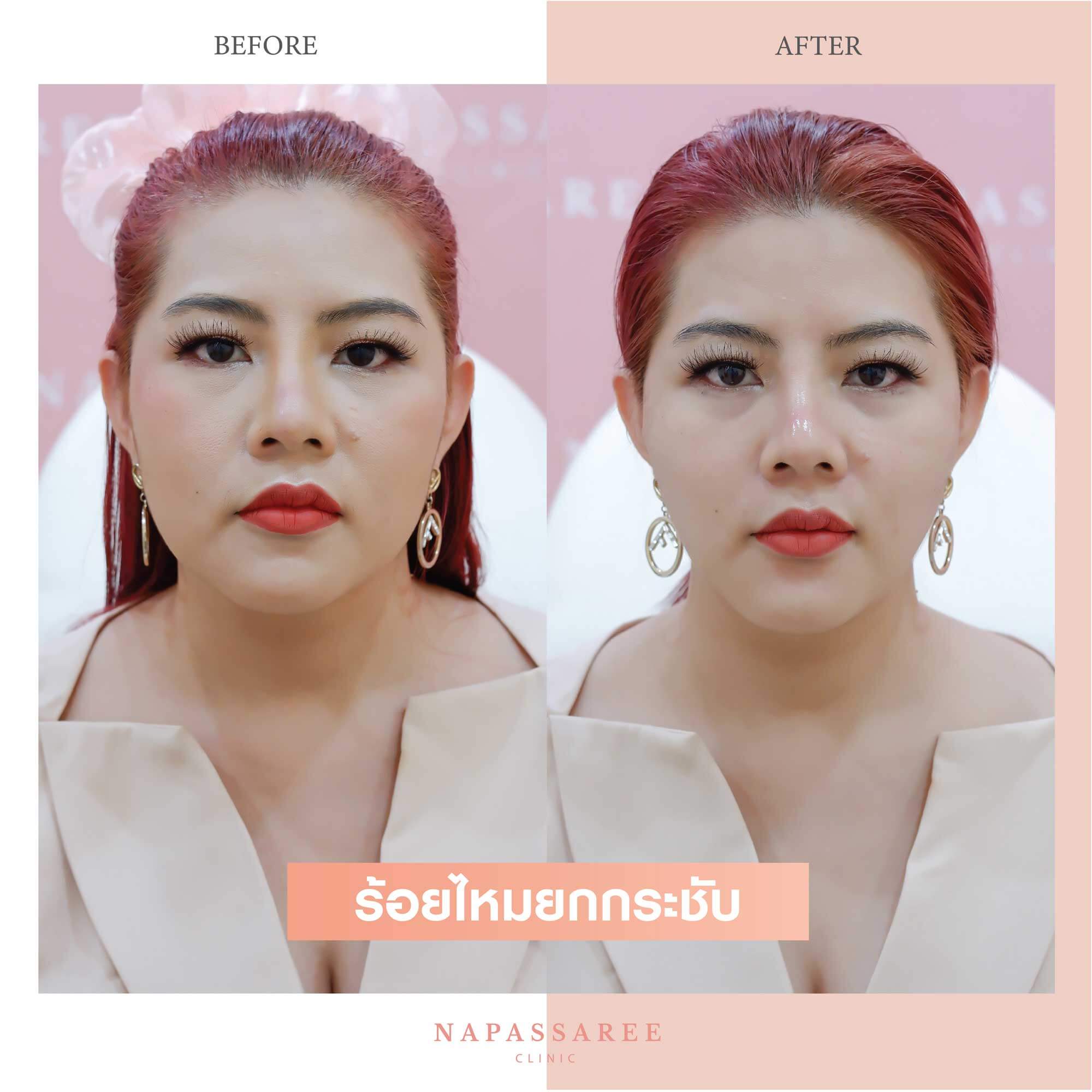 10 อันดับคลินิกร้อยไหม ที่ไหนดี มีรีวิวกันมากที่สุด 2025 1