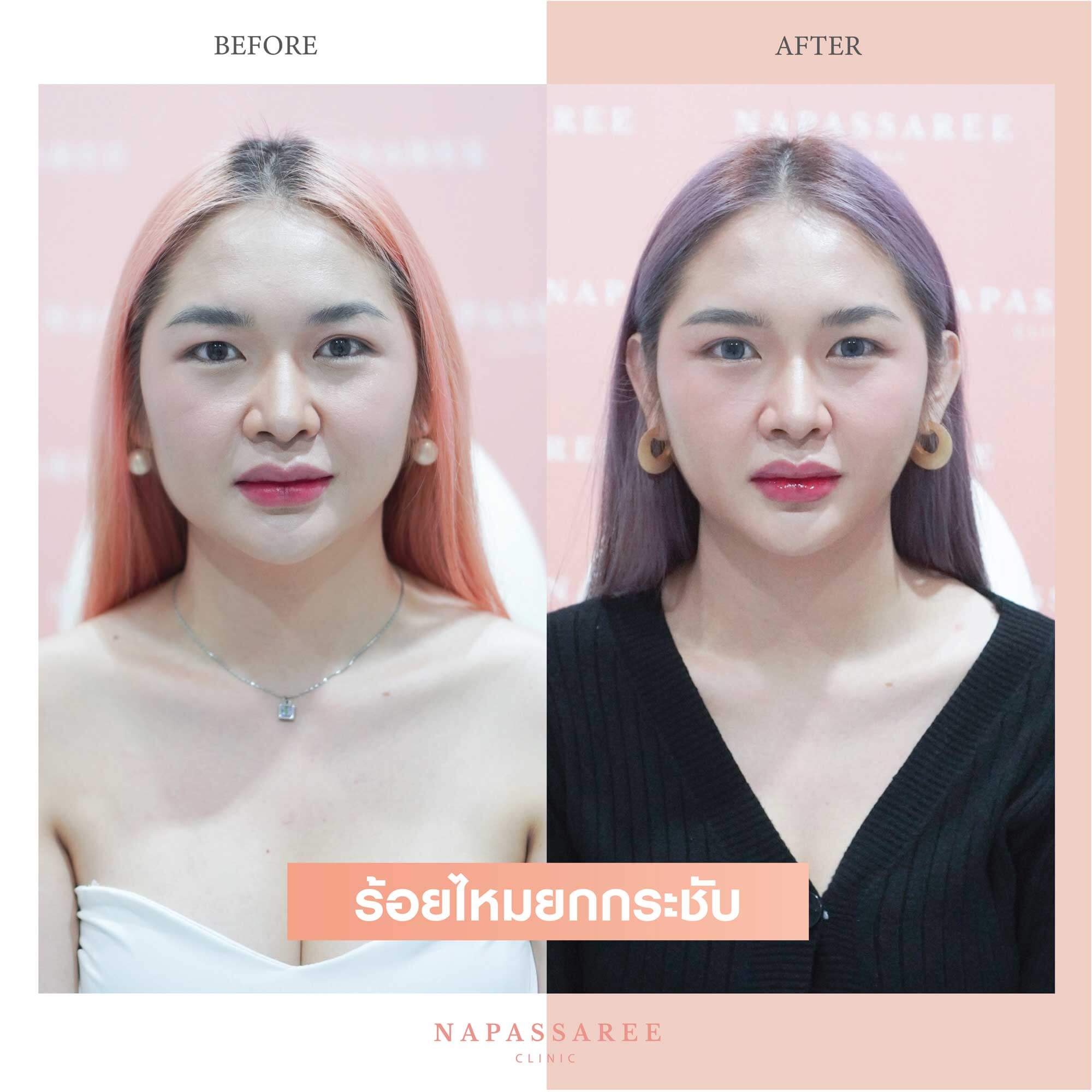 10 อันดับคลินิกร้อยไหม ที่ไหนดี มีรีวิวกันมากที่สุด 2025 2