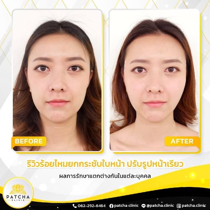 10 อันดับคลินิกร้อยไหม ที่ไหนดี มีรีวิวกันมากที่สุด 2025 5