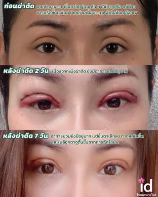 ID Hospital บริการทำตาสองชั้นสไตล์เกาหลี รวมเทคนิคกรีดตา ทำตา ทุกสไตล์ที่มีให้เลือก - 2