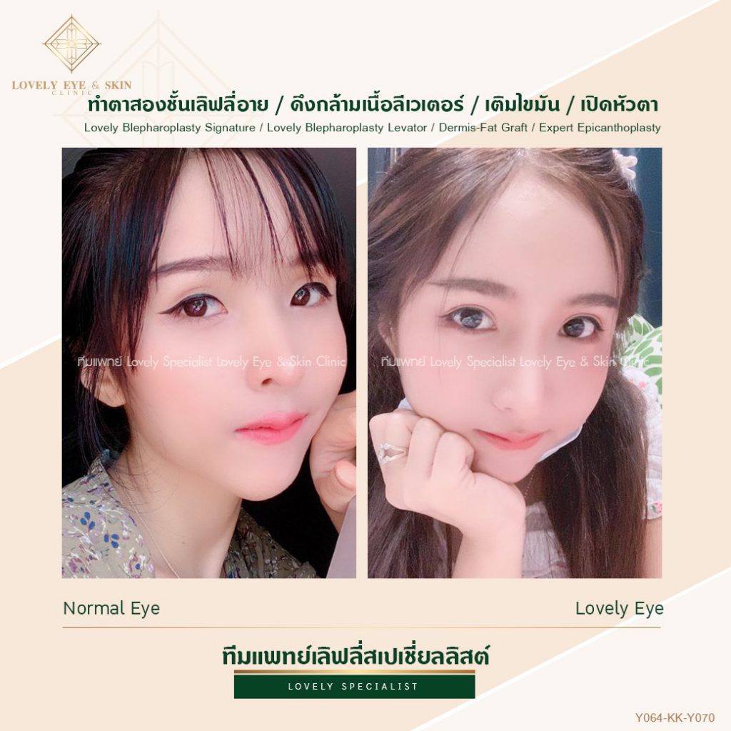 Lovely Eye and Skin Clinic ทำตาสองชั้นสไตล์เกาหลี สวยคม สวยมีสไตล์ทุกมุมมอง - 2