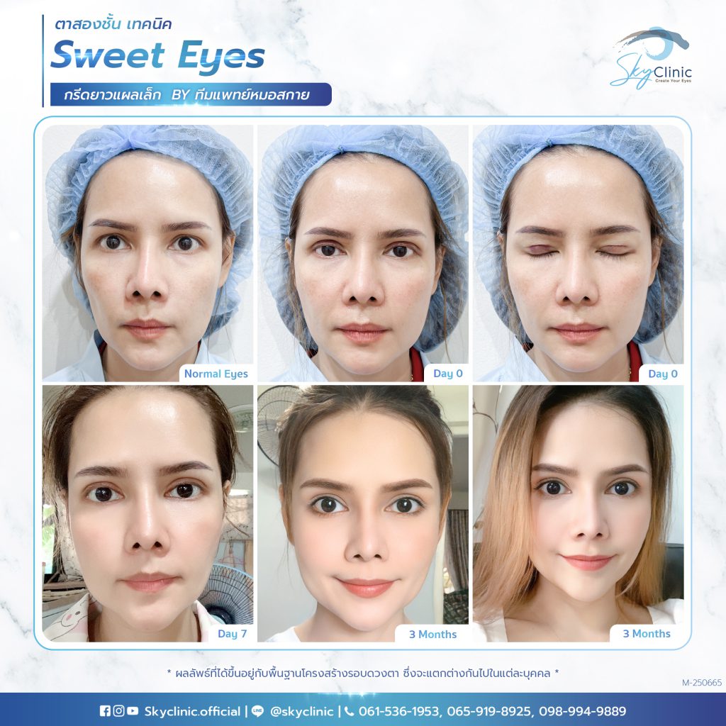 Sky Clinic ทำตาสองชั้นสไตล์เกาหลี รอยยิ้มดวงตาสดใส สไตล์ยอดนิยม - 2