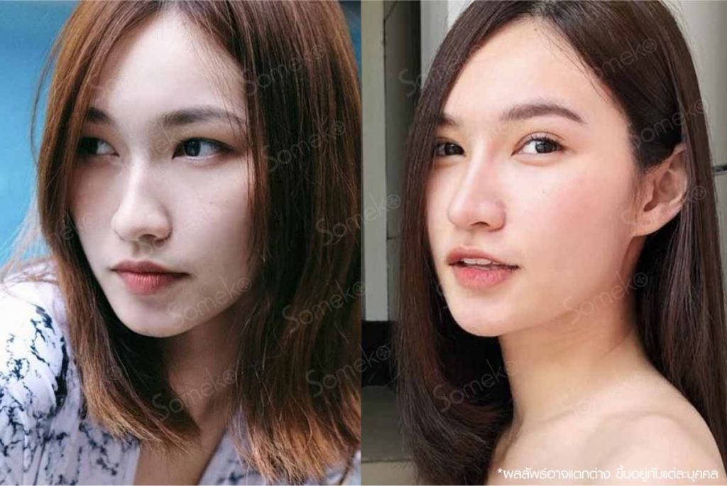 Someko Clinic ศัลยกรรมทำตาสองชั้นสไตล์เกาหลี เนียนกลมสวยเป็นธรรมชาติ - 2