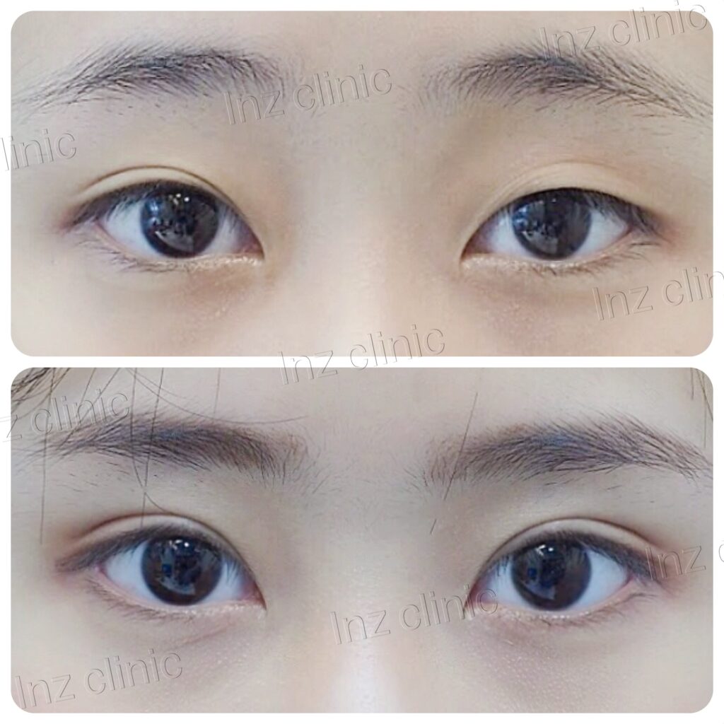 inZ Clinic เสริมตาสองชั้นสไตล์เกาหลี สวยมั่น ทุกสายตาที่เฉียบคมหลังทำ - 2