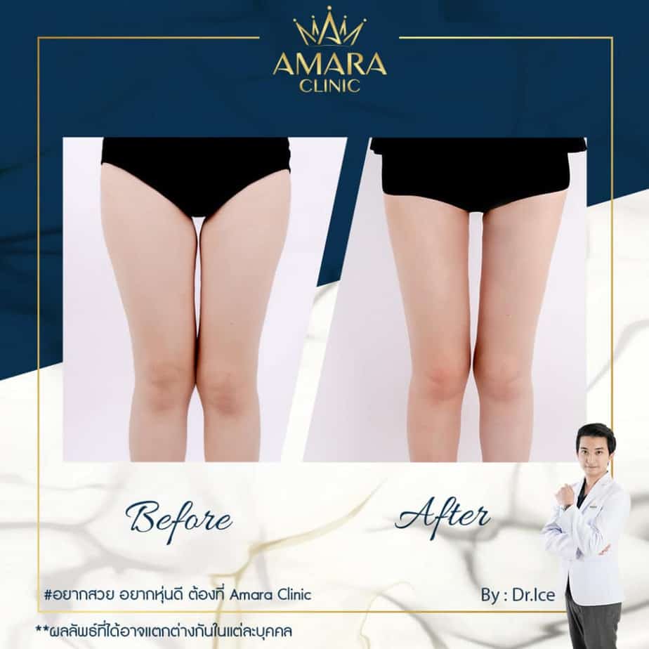 Amara Clinic ดูดไขมันต้นขา เปลี่ยนขาใหญ่เป็นขาตะเกียบทรงดี - 2