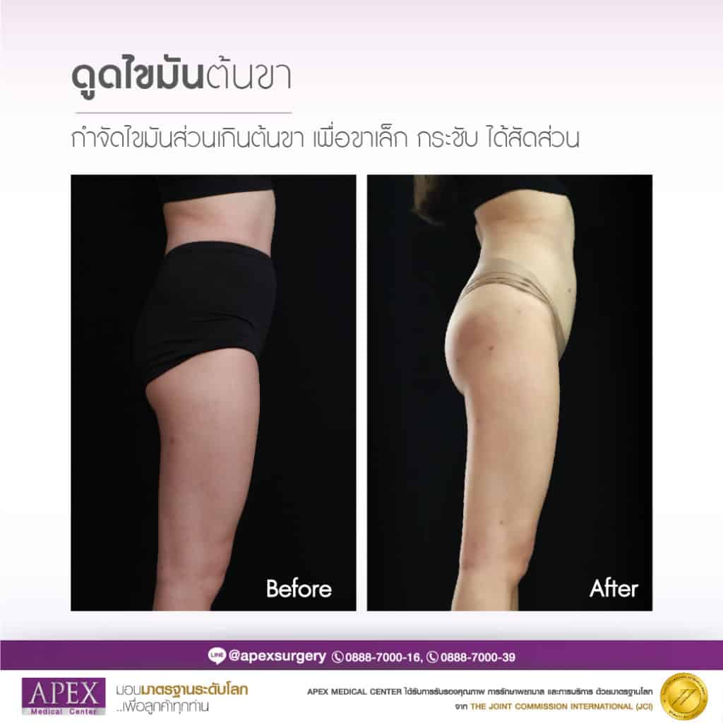 Apex Medical Center ดูดไขมันต้นขา ศูนย์เสริมความงามให้บริการชั้นนำ - 2
