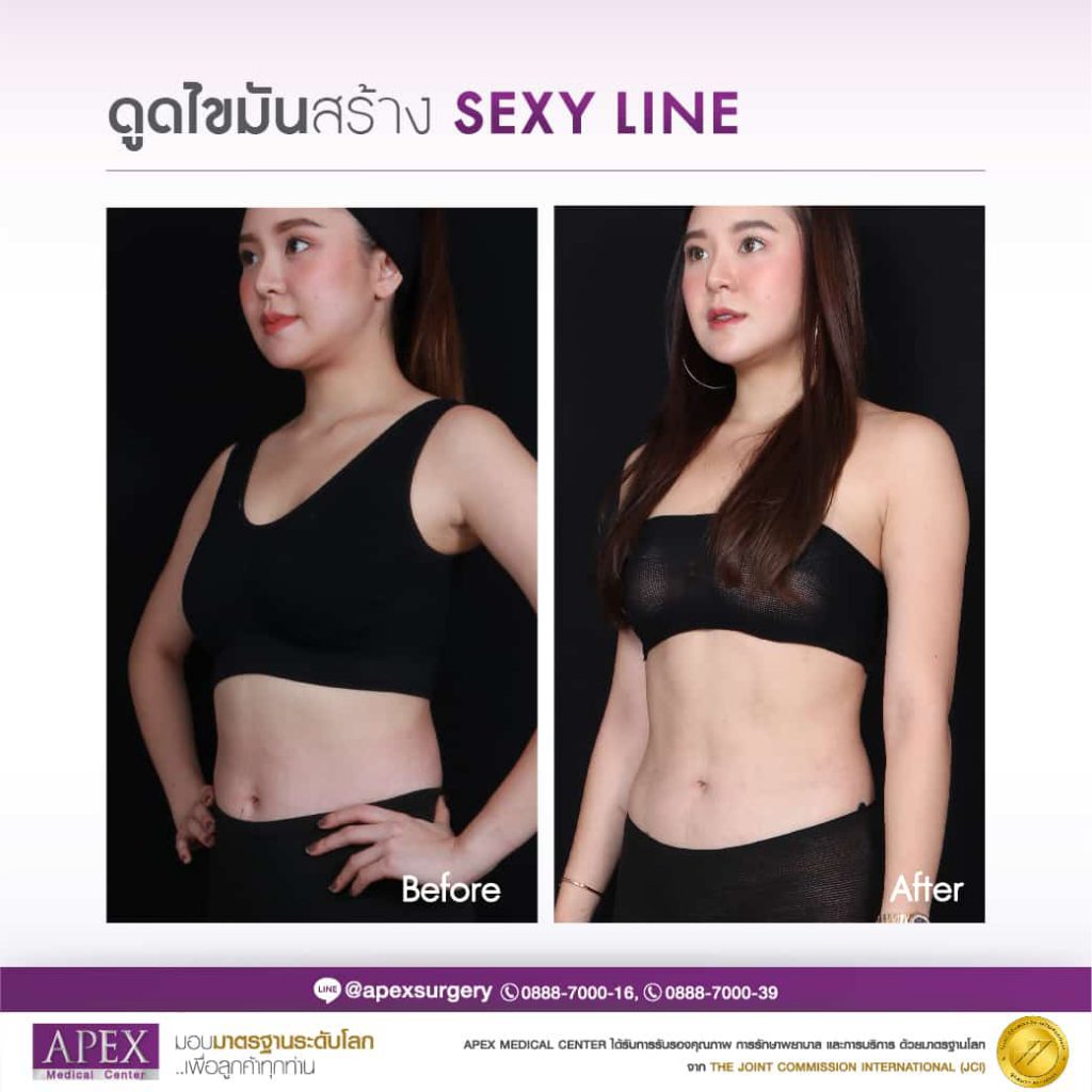 Apex Profound Beauty บริการดูดไขมันหน้าท้อง ปรับสรีระรูปร่างได้อย่างที่หวัง - 2