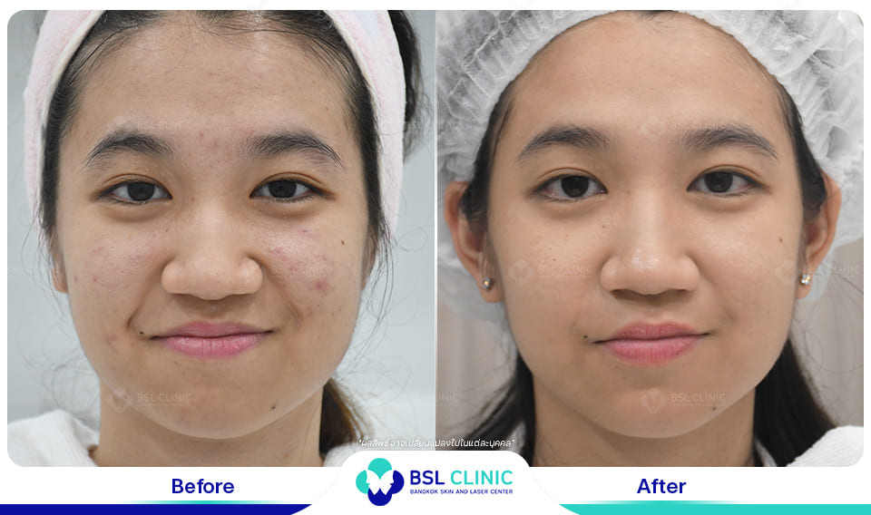 BSL Clinic ศูนย์บริการฉีดสิว รักษาปัญหาของสิวที่ลุกลาม หายชะงักทันที - 2