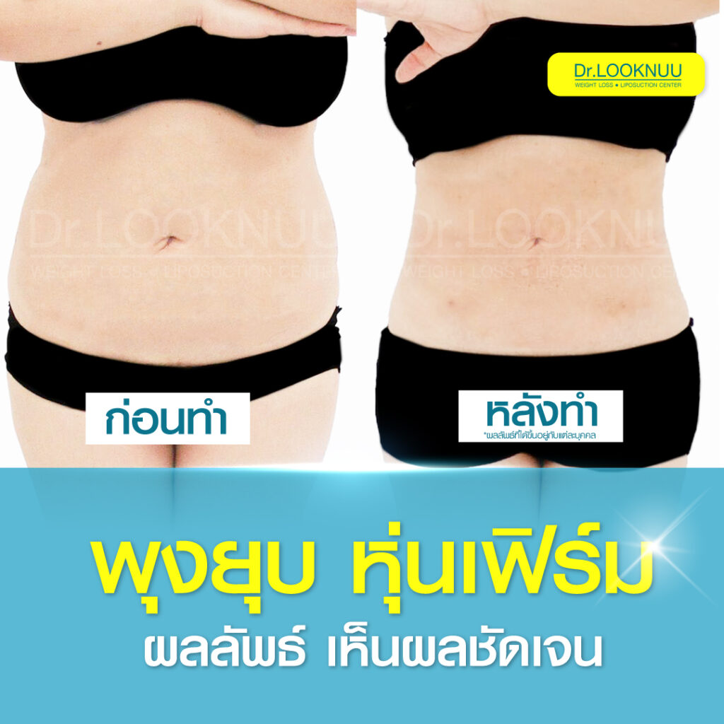 Dr.Looknuu Clinic บริการดูดไขมันหน้าท้อง คลินิกบริการแก้ปัญหาไขมัน สัดส่วน และรูปร่าง - 2