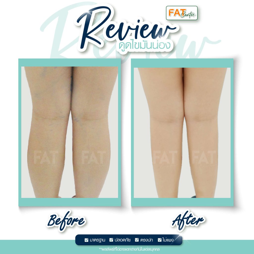 Fat Center คลินิกดูดไขมันต้นขา เรียวกระชับ ดูดไขมันส่วนเกิน ปลอดภัยทุกขั้นตอน - 2