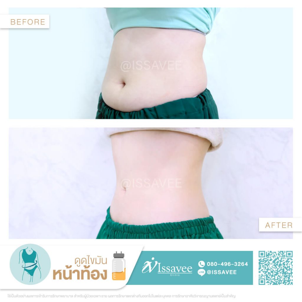 Issavee Clinic คลินิกดูดไขมัน หุ่นผอม ปรับเอวทรง XL ให้เป็น S ได้ไม่ยาก - 2
