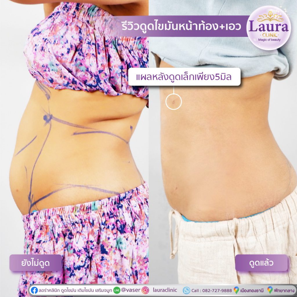Laura Clinic คลินิกดูดไขมันหน้าท้อง กระชับหน้าท้องดูดไขมันด้วย Bodytite , Jet , Vaser - 2