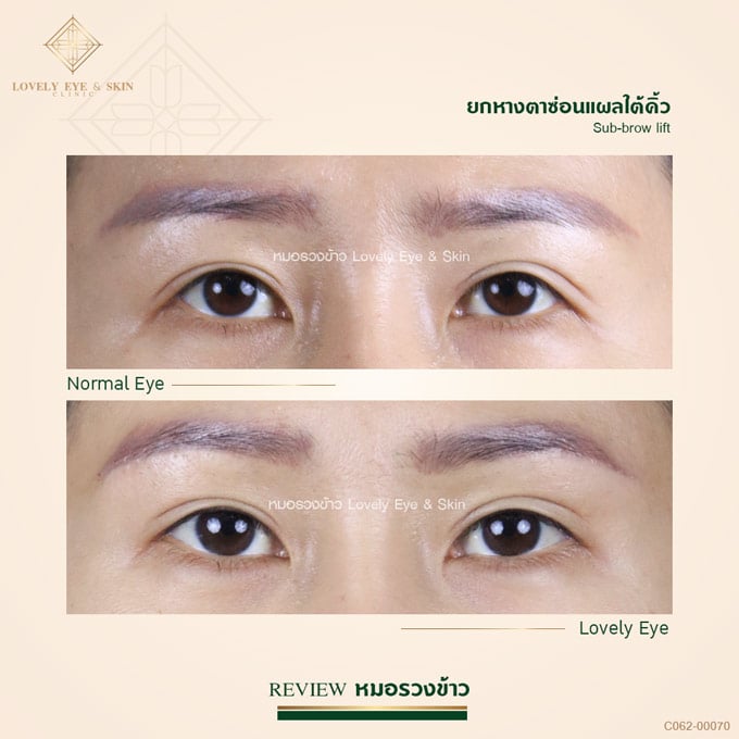 Lovely Eye and Skin Clinic คลินิกยกคิ้ว สร้างความกระชับ ยกคิ้วทรงสวยหลังทำ - 2