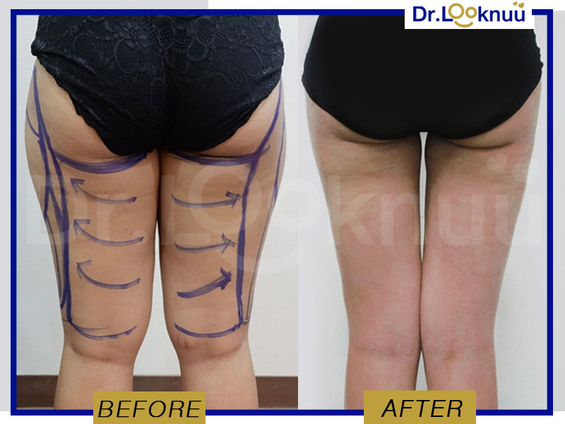 Marvelous clinic บริการดูดไขมันต้นขา จากหมอลูกหนู ผู้เชี่ยวชาญเรื่องไขมันส่วนเกิน - 2