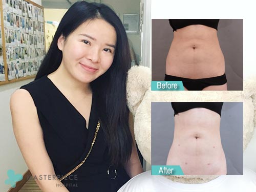 Masterpiece Hospital บริการดูดไขมันหุ่นผอม Vaser LipoSuction หุ่นเฟิร์ม กระชับทุกจุด - 2