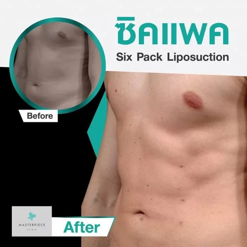 Masterpiece Hospital ดูดไขมันสร้าง Six Pack ที่ดีที่สุด สร้างหุ่นเฟิร์ม หุ่นปัง ดูดีได้อย่างมั่นใจ - 2