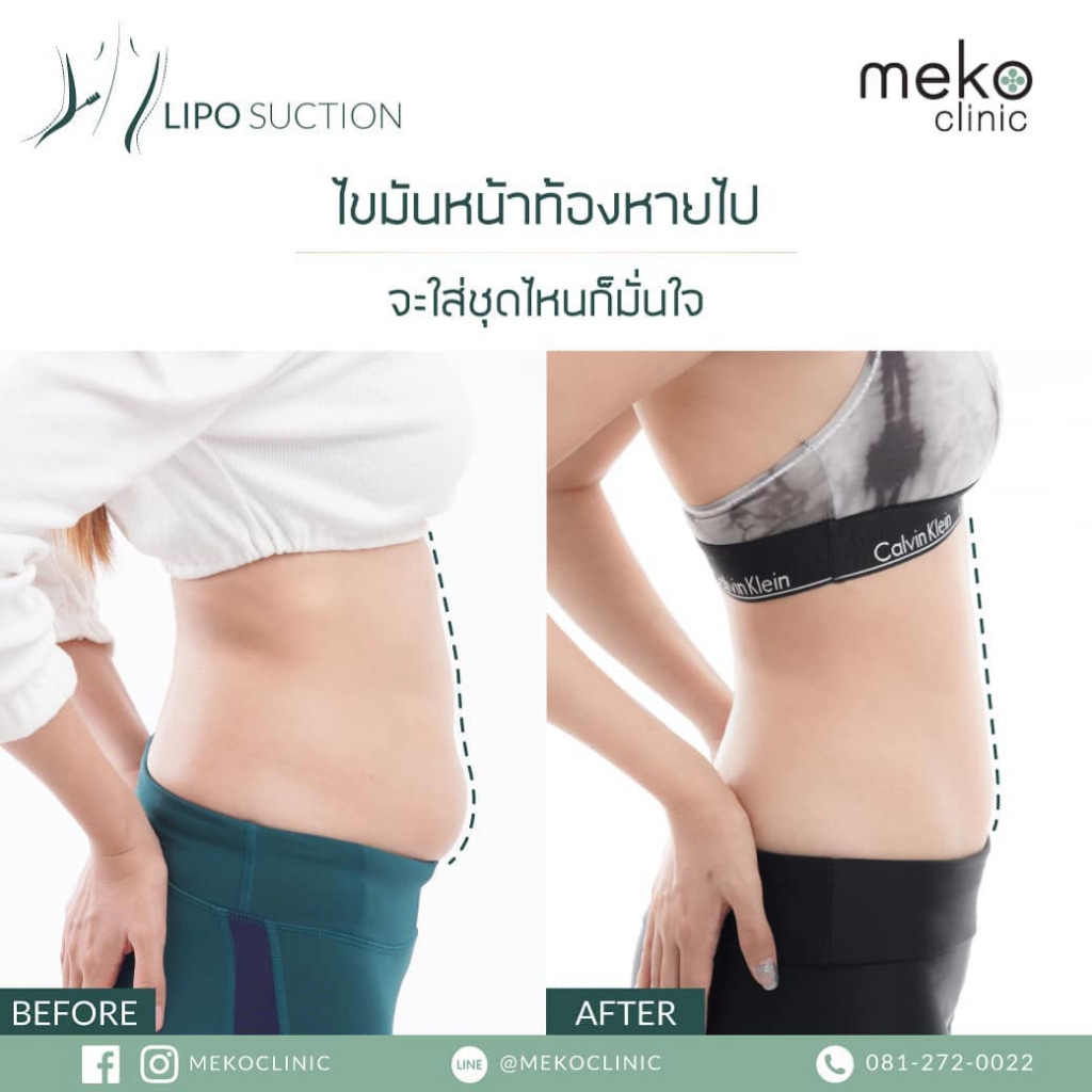 Meko Clinic ดูดไขมันเฉพาะส่วน ปรับรูปแบบของสัดส่วนที่ดูใหญ่ให้เล็กลงไป - 2