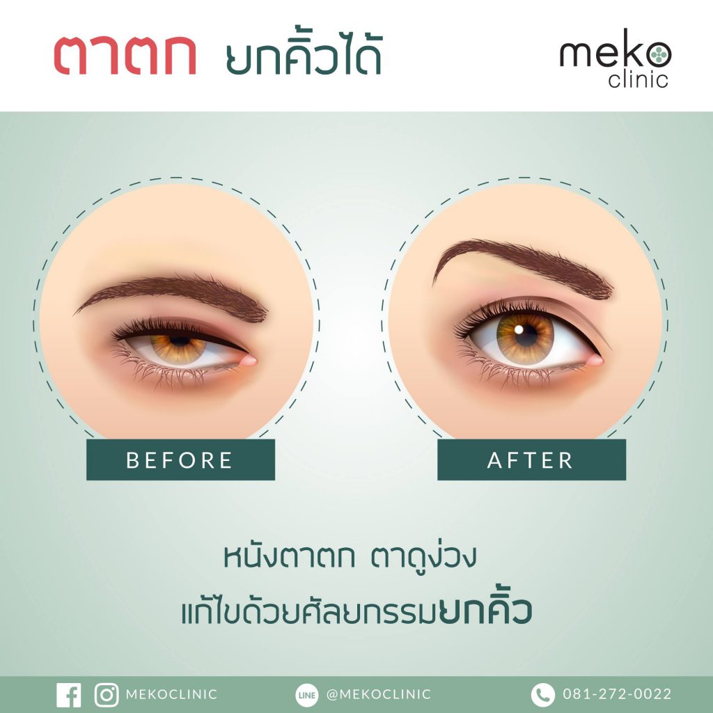 Meko Clinic ศัลยกรรมยกคิ้ว แก้คิ้วตก หนังตาหย่อน เปลี่ยนอารมณ์ให้ใบหน้าเห็นผลทันที - 2