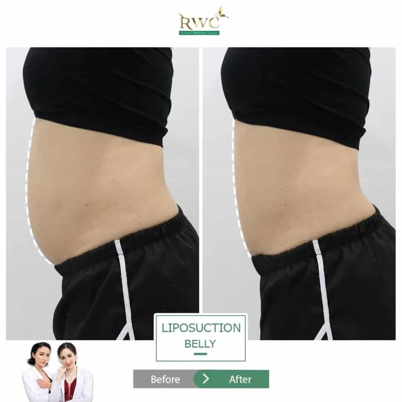 RWC Clinic คลินิกดูดไขมันหน้าท้อง ขจัดปัญหาไขมันส่วนเกินบริเวณหน้าท้อง ต้นแขน ต้นขา - 2