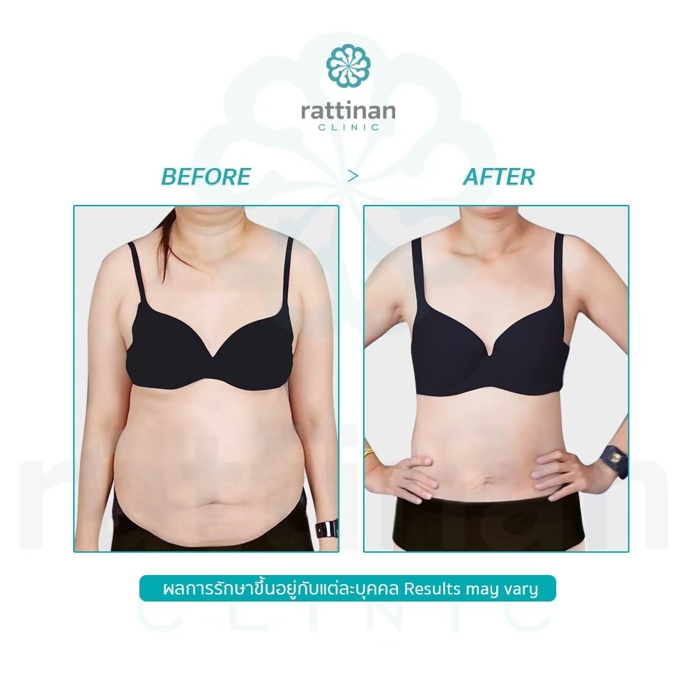 Rattinan Clinic คลินิกดูดไขมันหน้าท้อง ลดการเกิดไขมันสะสม ไขมันส่วนเกินให้หมดไป - 2