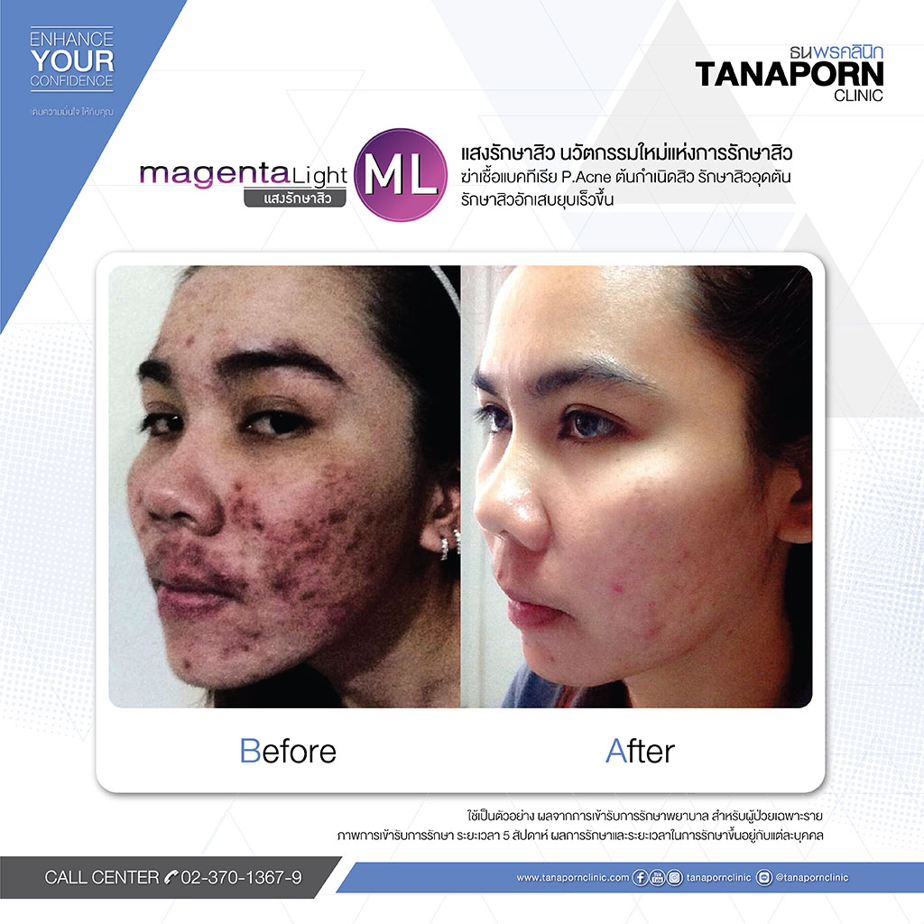 Tanaporn Clinic ฉีดรักษาสิว ปรับรูปหน้าให้ขาวใส ไร้สิว ได้อย่างไม่ต้องกังวล - 2