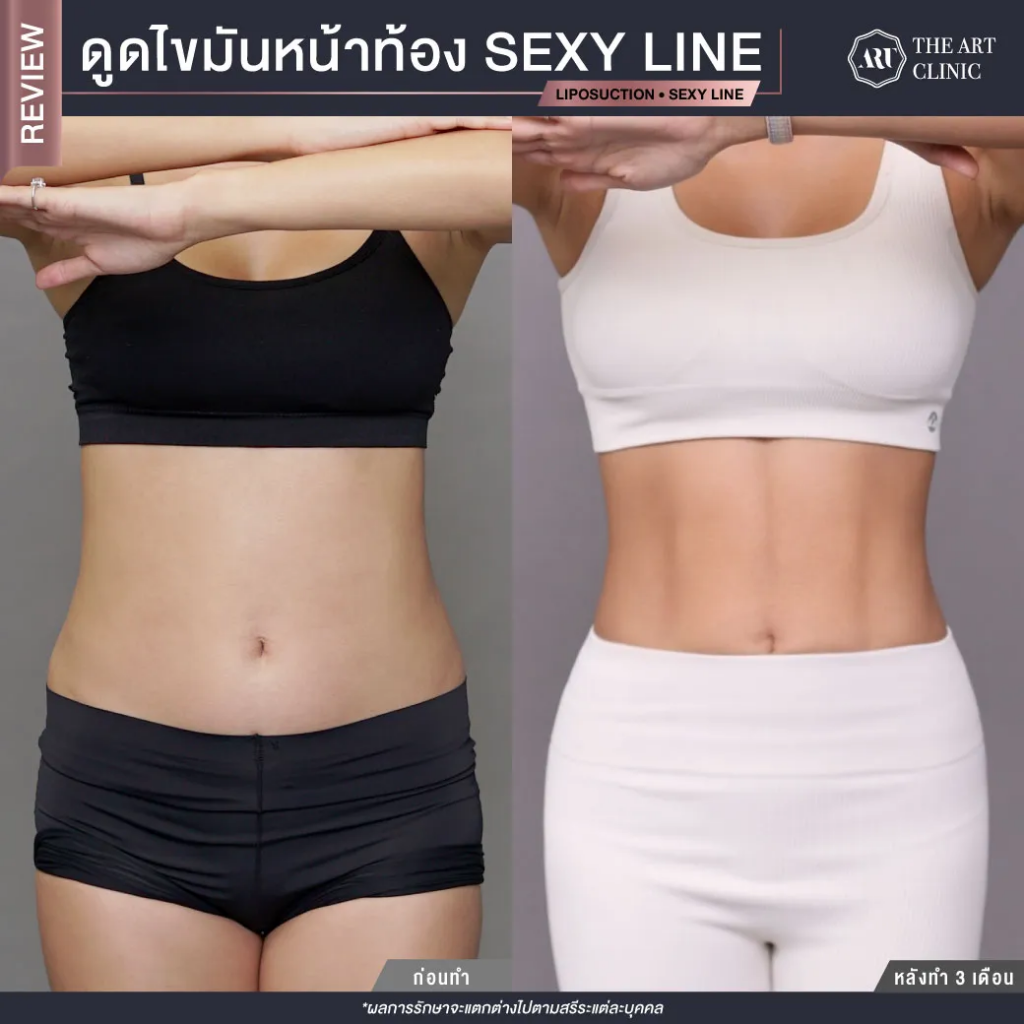 The Art Clinic คลินิกดูดไขมัน หุ่นผอม หุ่นปัง หุ่นเฟิร์ม ทุกจุดหลังทำการดูด - 2