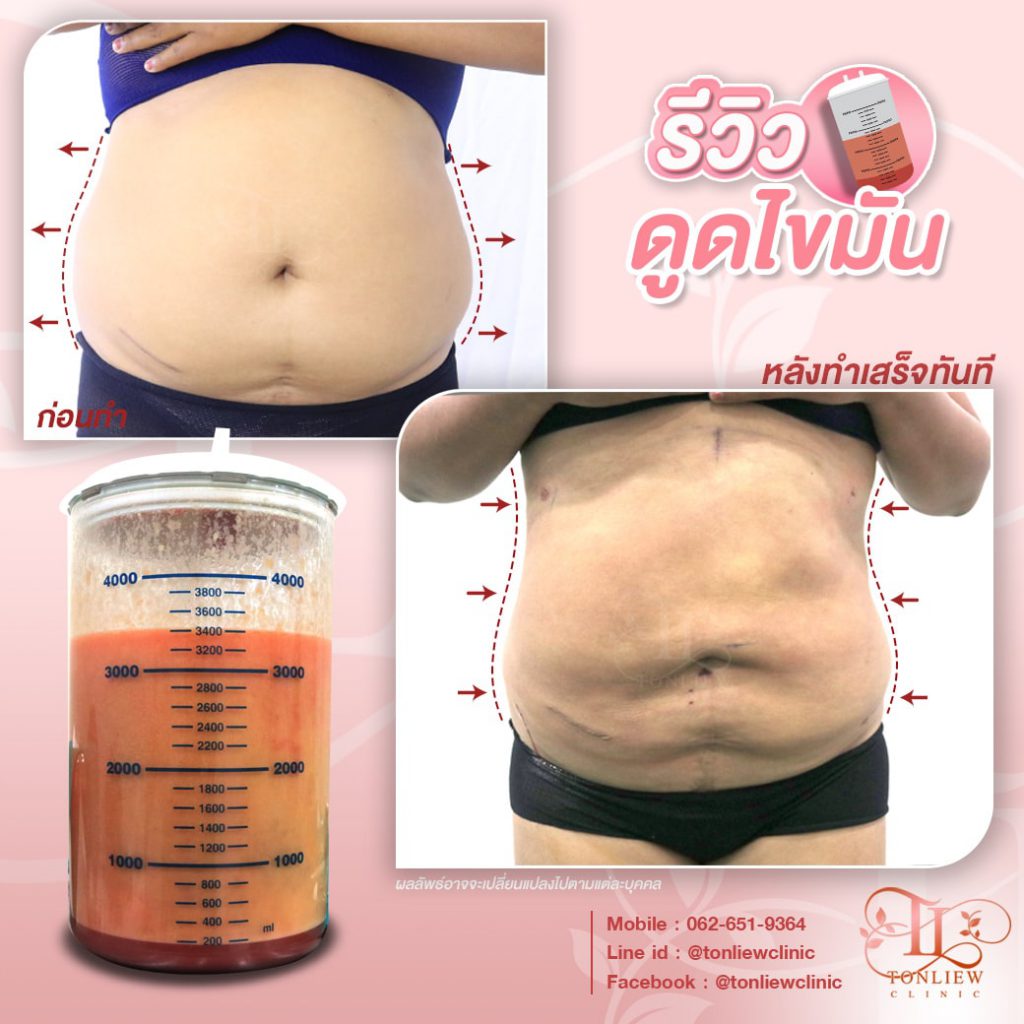 Tonliew Clinic ดูดไขมันหน้าท้อง ราคาดี โปรโมชั่นโดนใจลูกค้าทุกคน - 2
