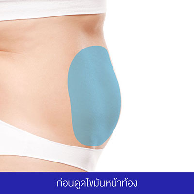 Yanhee Hospital ดูดไขมันหน้าท้องที่ดีที่สุด บริการดี กำจัดไขมันส่วนเกินกระชับทุกสัดส่วน - 2