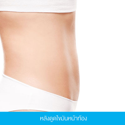 Yanhee Hospital ดูดไขมันหน้าท้องที่ดีที่สุด บริการดี กำจัดไขมันส่วนเกินกระชับทุกสัดส่วน - 3