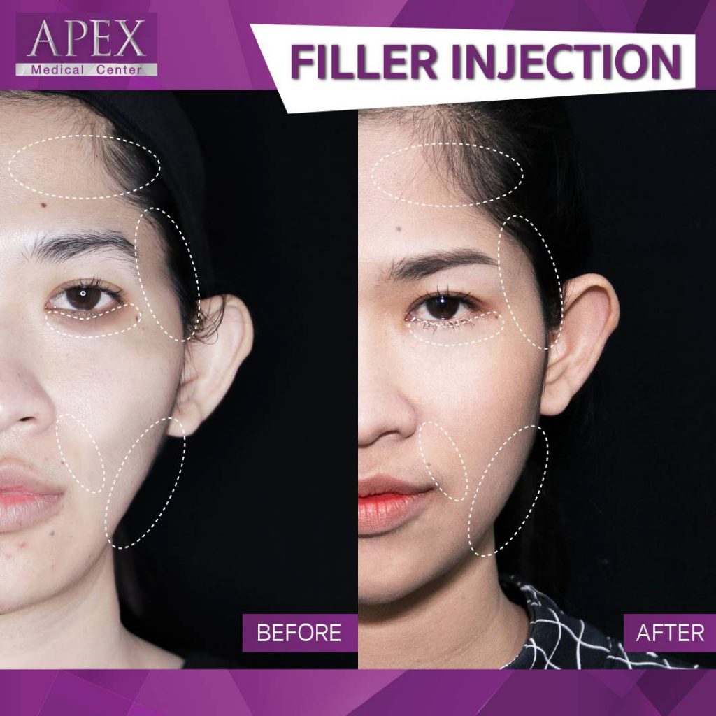 Apex Beauty คลินิกฉีดฟิลเลอร์ เซ็นทรัลโคราช เติมฟิลเลอร์ผิวเสริมจุดเด่นผิวหน้าชัดยิ่งขึ้น - 2