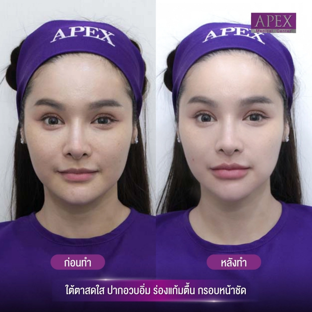 Apex Medical Center คลินิกโบท็อก พัทยา ดูแลให้บริการโดยแพทย์ผู้เชี่ยวชาญเฉพาะทาง - 2