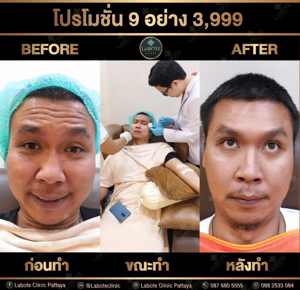 Labote Clinic คลินิกฉีดโบท็อก พัทยา รวมบริการเสริมความงามผิวหน้าดูเด็กได้อีกครั้ง - 2